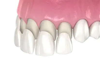 Dental Veneers Process